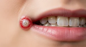 구내염 옮나요 원인부터 치료 예방까지 완벽정리